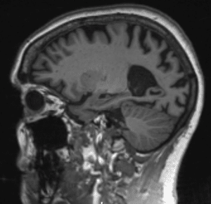 Brain Scan of Person With Alzheimers Disease. The brain appears shrunken